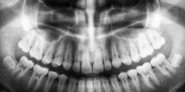 zdrowe zęby, leczenie stomatologa