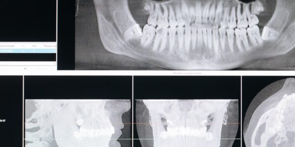 ile kosztuje implant zęba