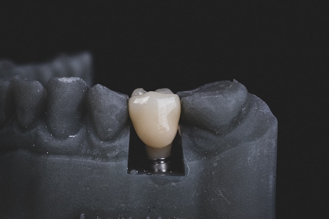 dobór implantów do swoich zębów
