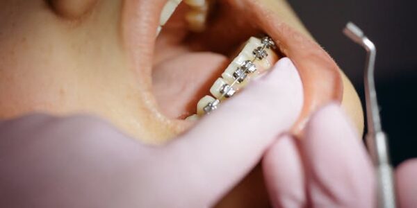 aparat Frankla w ortodoncji